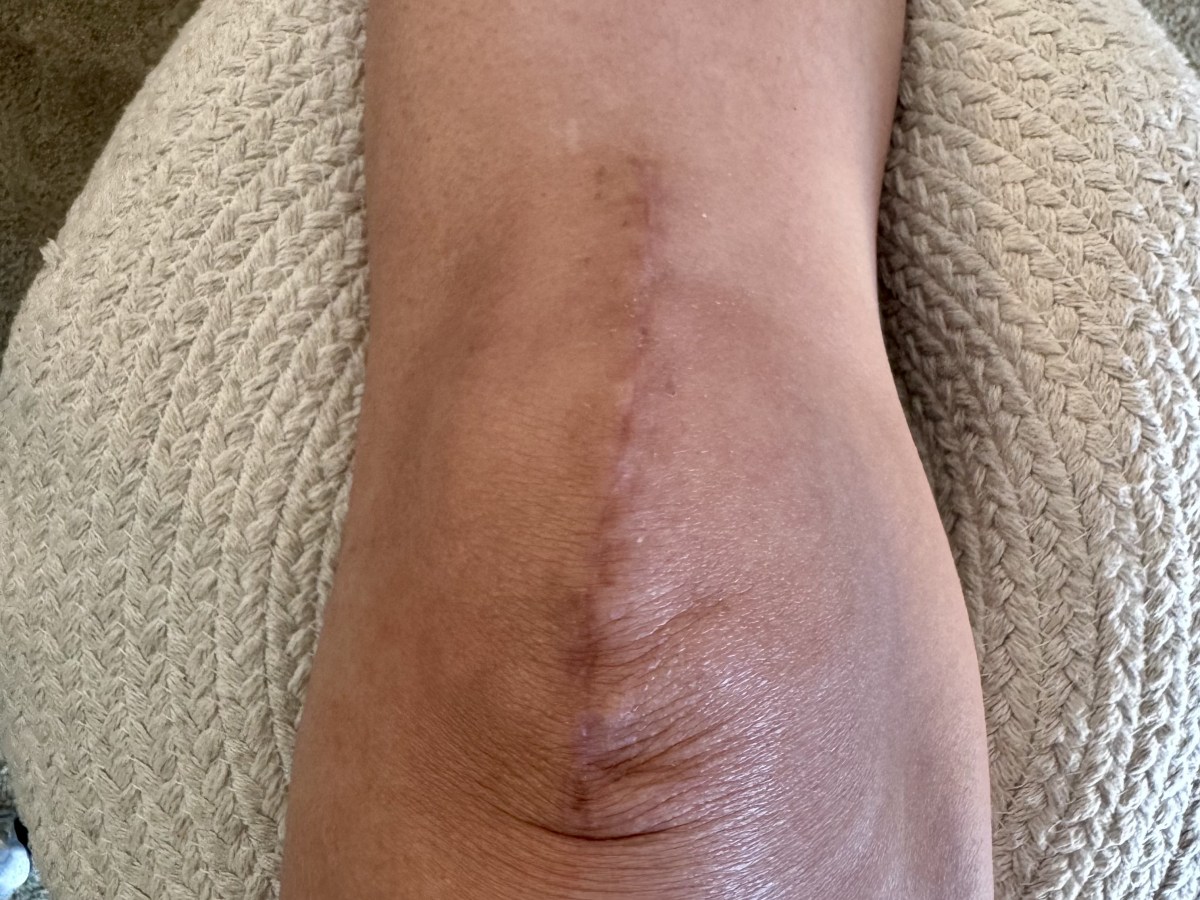 Two Months After Knee&nbsp;Surgery