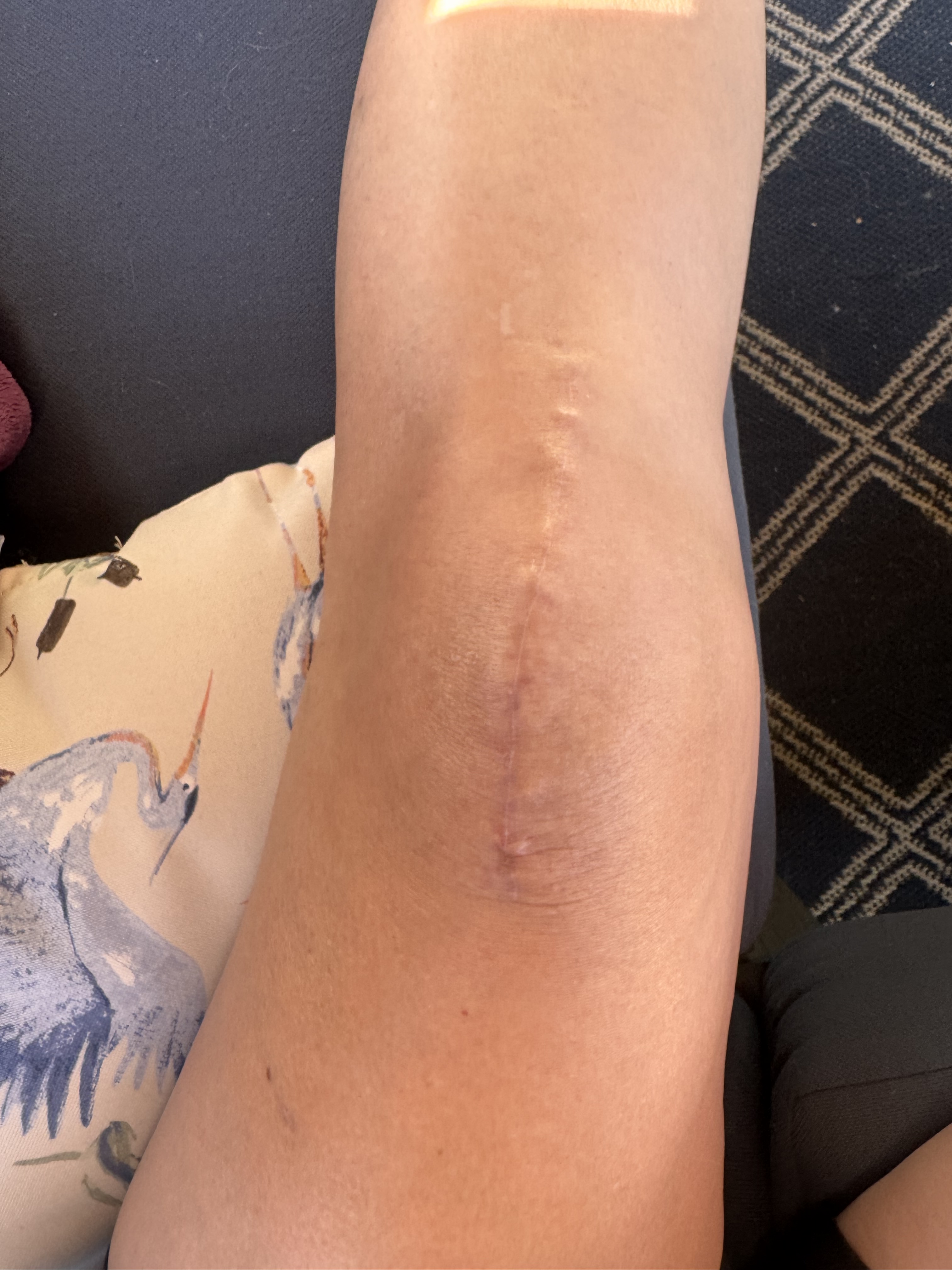 Three Months After Knee Replacement: Getting Back to Normal, One Step ...