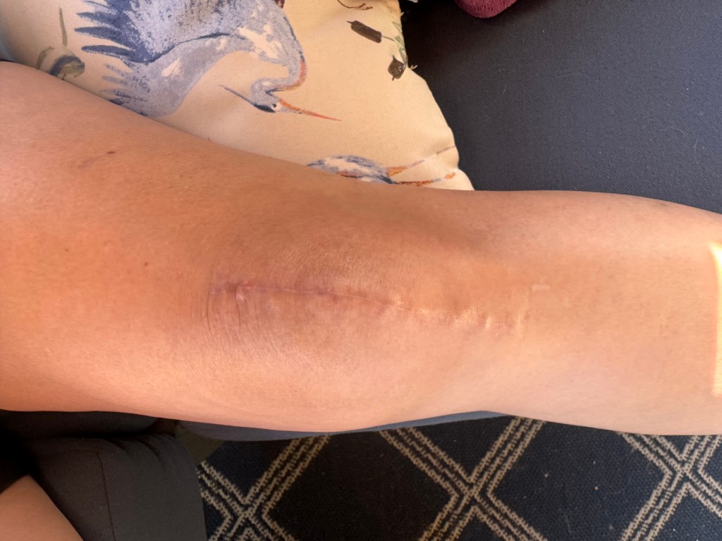3 months post knee surgery